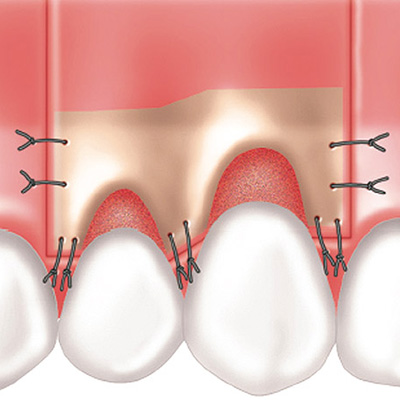 잇몸 이식수술